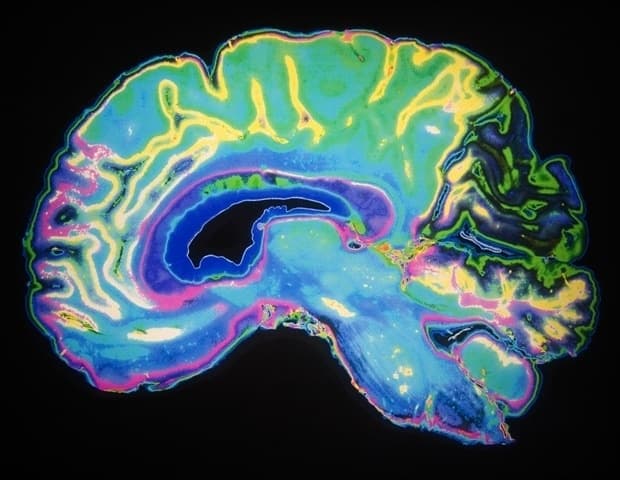 U-M Health neurosurgeons complete first human implant of wireless brain computer interface